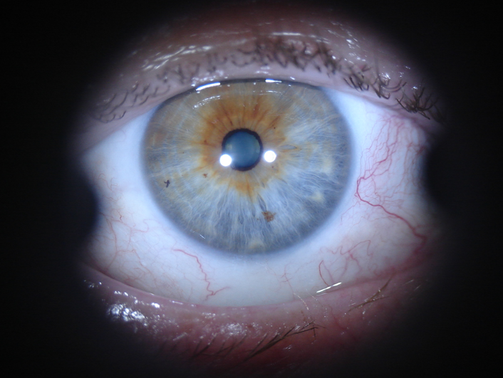 Exemplo de íris com Diathesis I